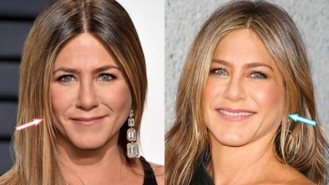 Jennifer Aniston’s Plastic Surgery: What Has She Done to Her Face?